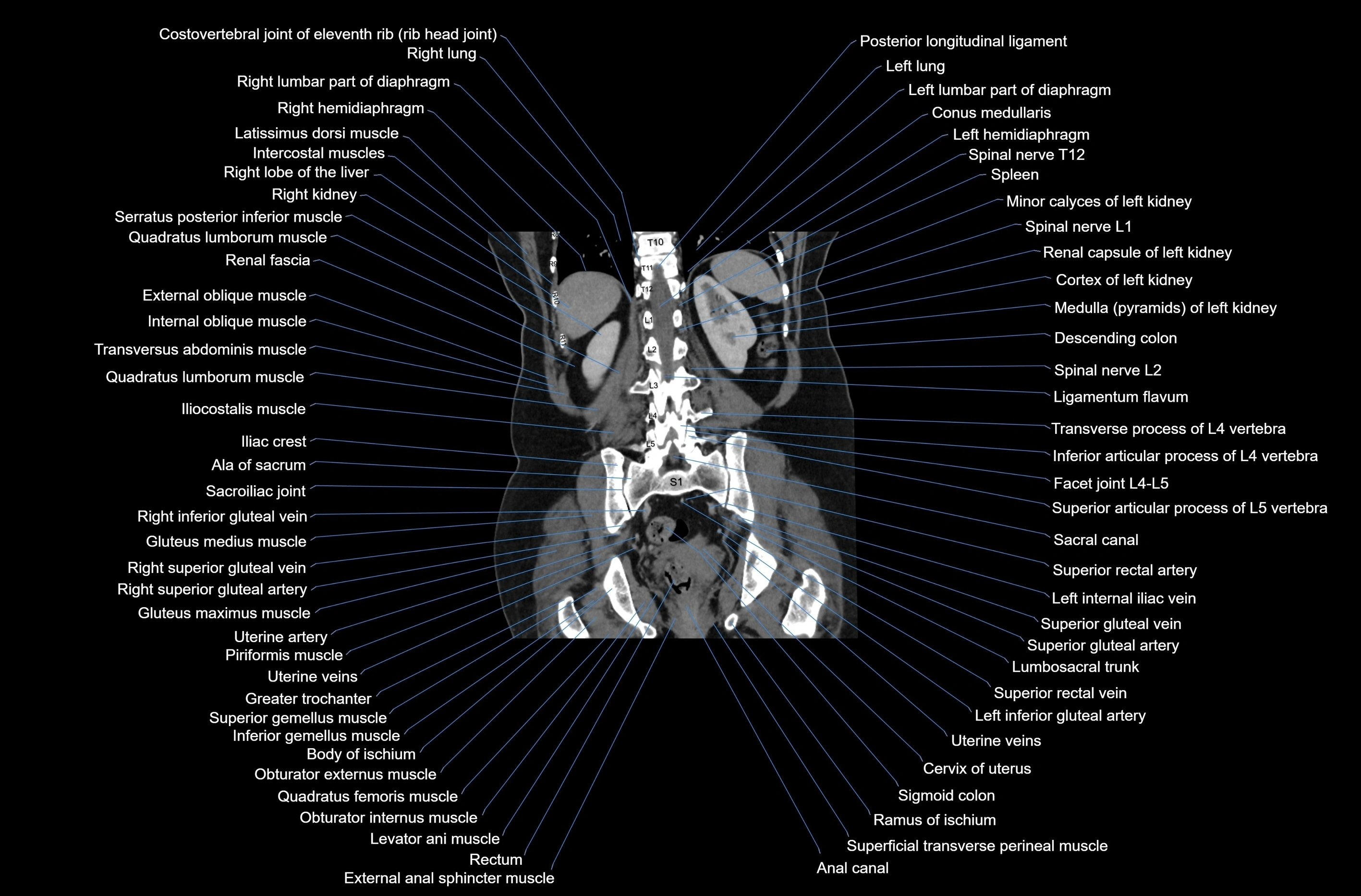 CT abdomen coronal cross sectional anatomy labelled radiology image-00063.webp